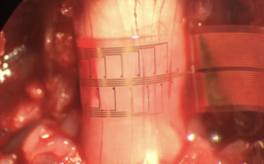 Could new implants treat depression, dementia and chronic pain?